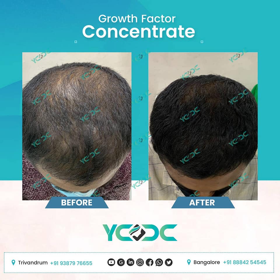 Before & After - YCDC