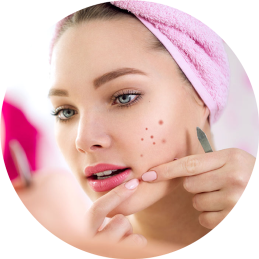 pimples-treatment