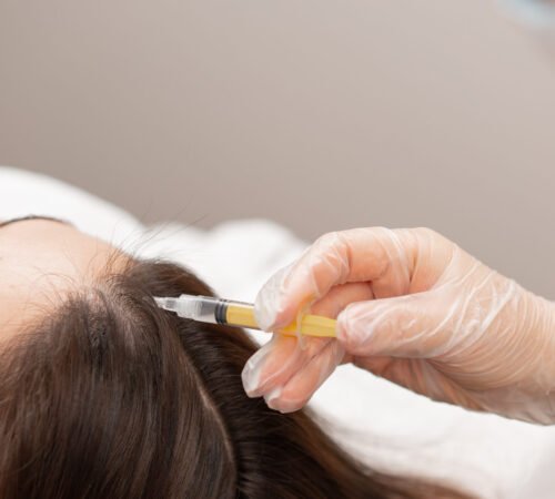 A beautician makes injections into the scalp for hair growth Mesotherapy for hair growth and strengthening in beauty salon A procedure against hair loss