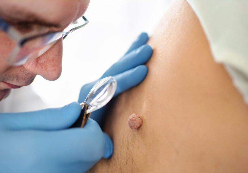 Medical professional inspects skin growth in a clinical setting.