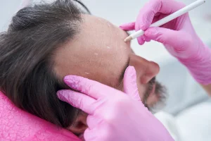 hair-transplant