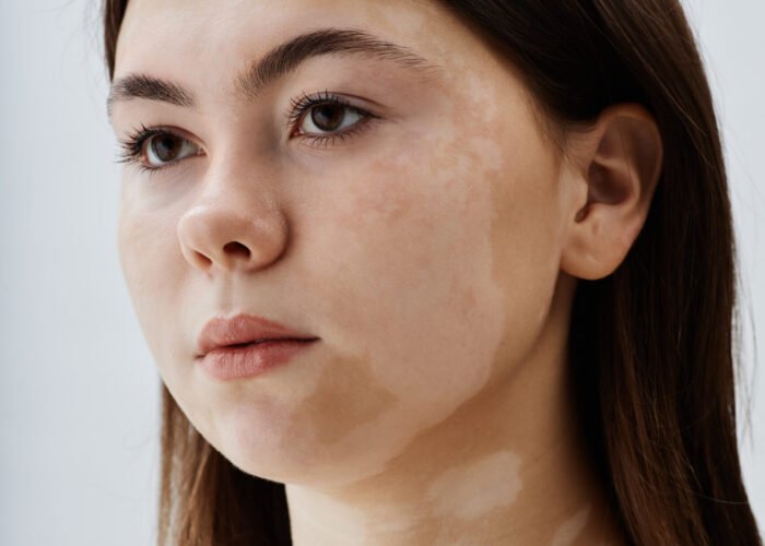 Vertical portrait shot of pretty brown eyed girl with vitiligo confidently posing in studio against white background embracing natural beauty of unique patches pattern