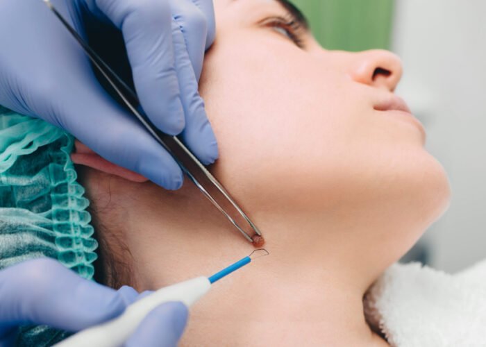 procedure removing mole. radio wave electrocoagulation method
