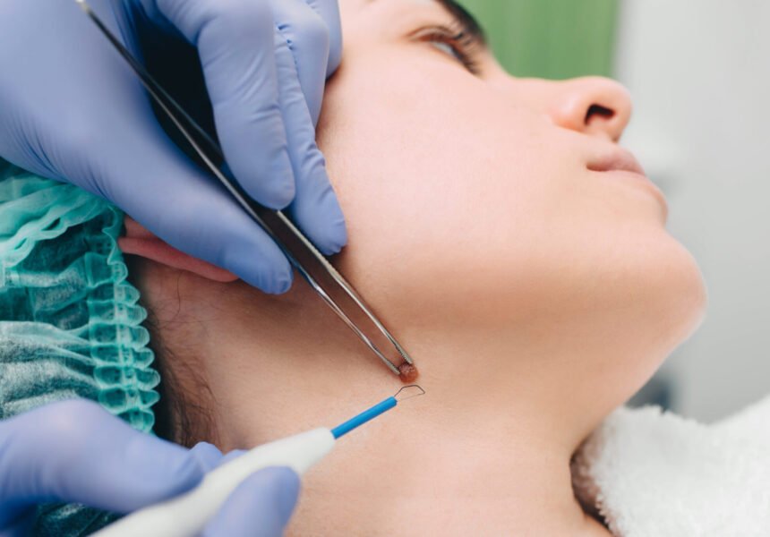 procedure removing mole. radio wave electrocoagulation method
