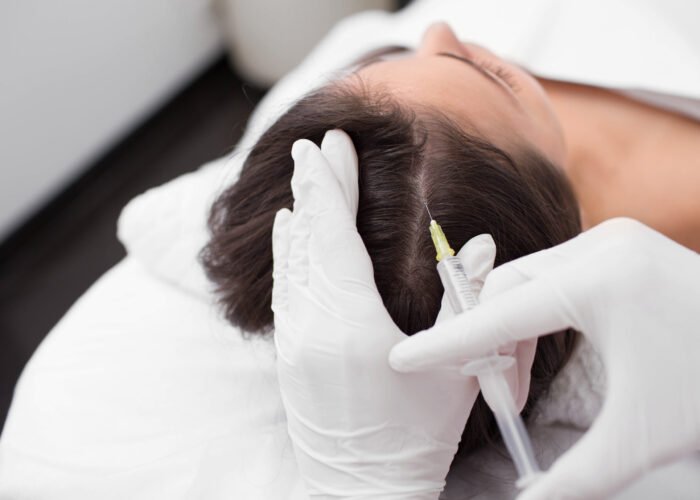 treatment of hair loss, injection for hair growth. Injected in woman's head, hair mesotherapy