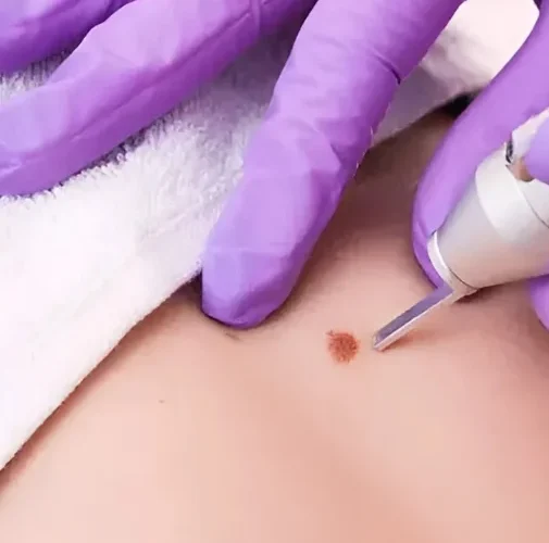 warts-removal