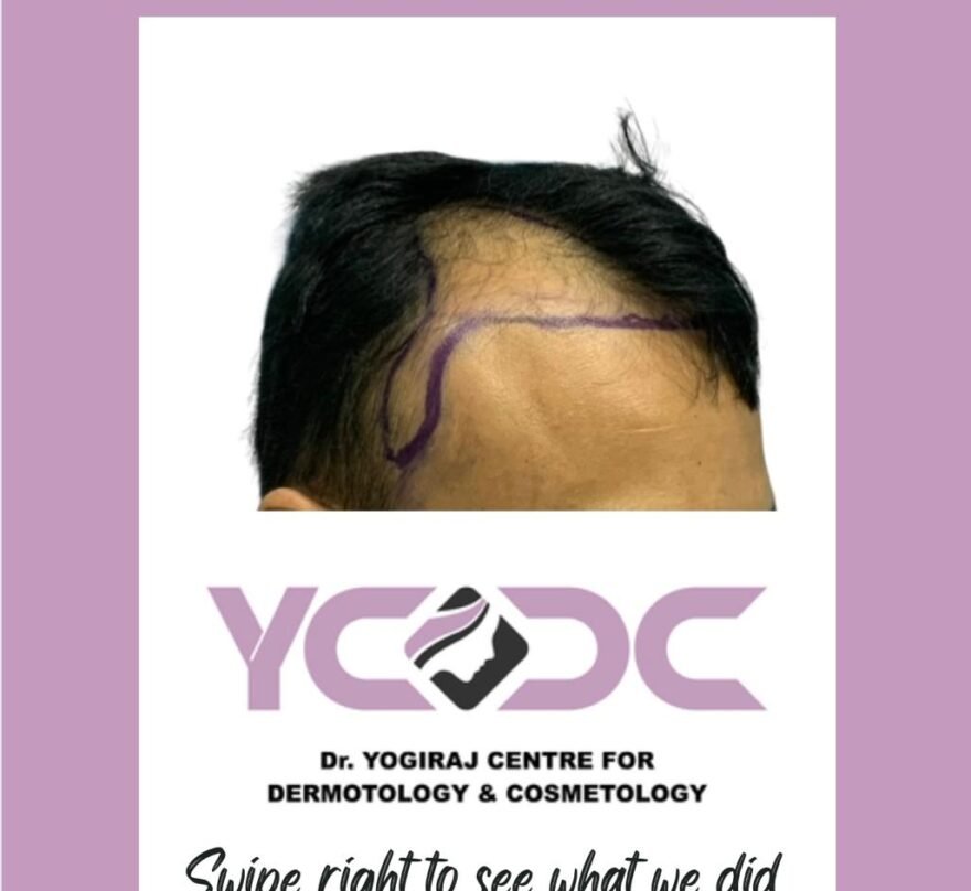 ycdc- before after6